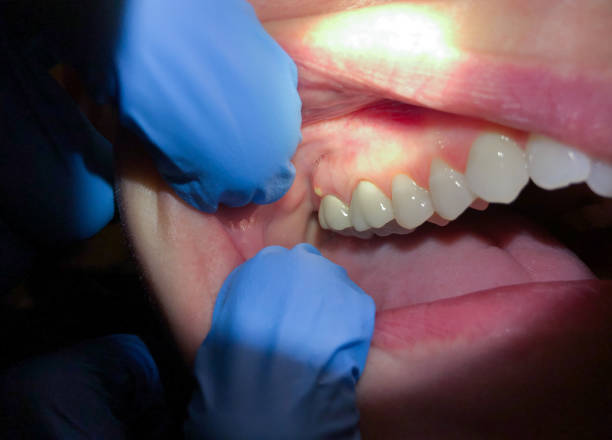 Teeth Whitening in OR